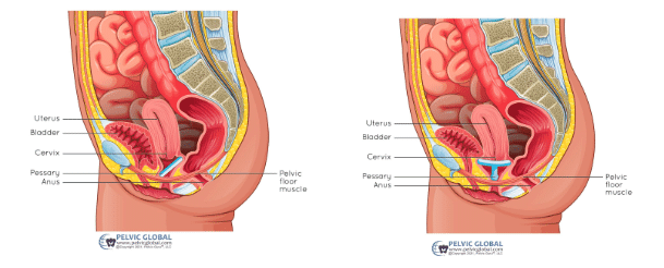 Anatomical diagram comparing the pelvic floor without a pessary and with a pessary, showing how a pessary supports prolapsed organs and relieves pressure.
